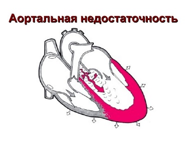 ИБС.png