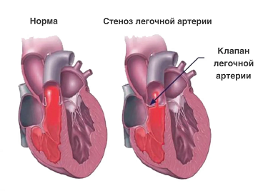 ИБС.png