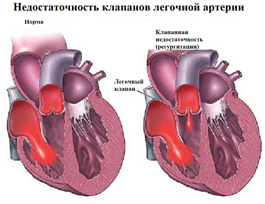 ИБС.png