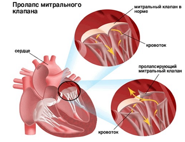 ИБС.png