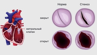 ИБС.png