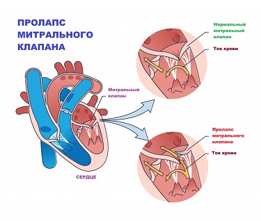ИБС.png