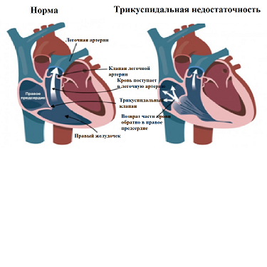 ИБС.png