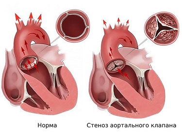 ИБС.png