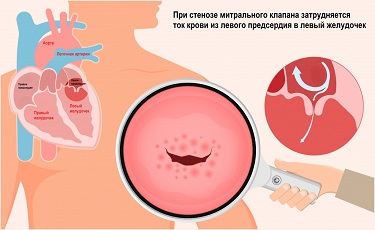ИБС.png