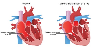 ИБС.png