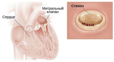 ИБС.png